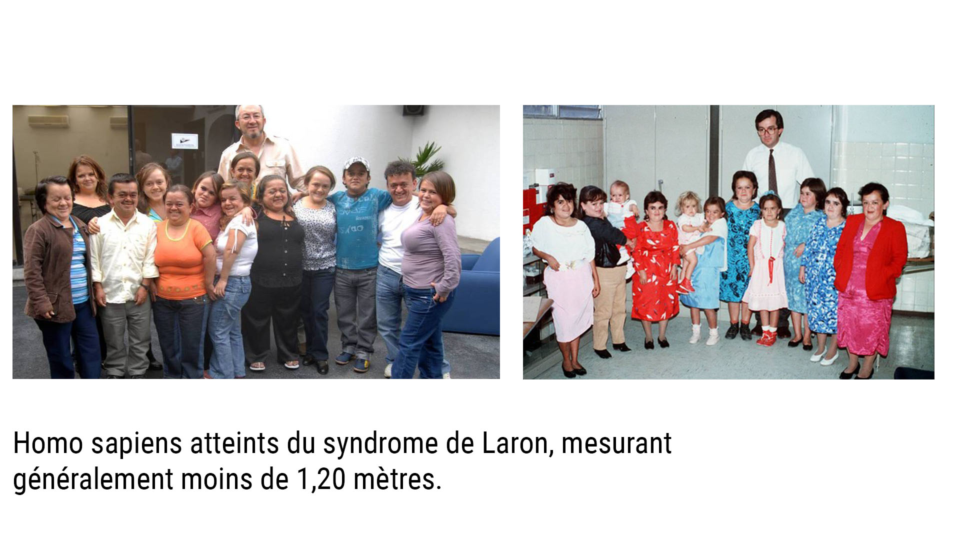 Syndrome de Laron